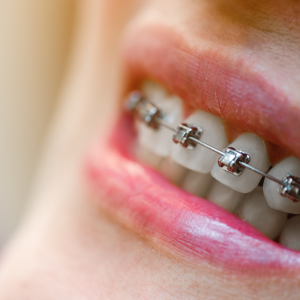 SELF LIGATING BRACES